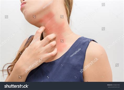 Itchy Rash On Neck Only