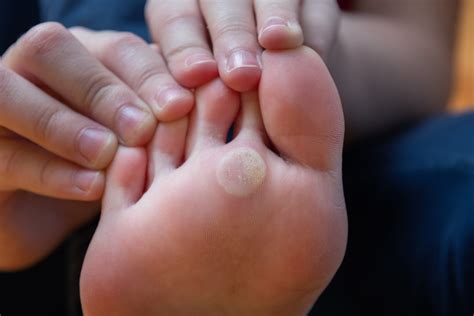 Foot Corns & Callus - Causes, Symptoms, and Remedies