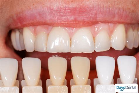 Are Veneers Permanent? Everything You Need to Know