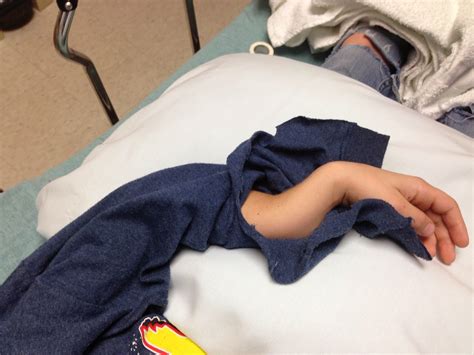 What Does A Broken Arm Feel Like at Rita Eustice blog