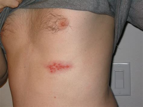 Shingles | Herpes Zoster | Geeky Medics