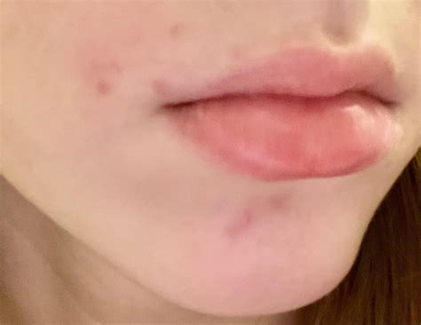 [Routine Help] Pimple problems around my mouth : r/SkincareAddiction