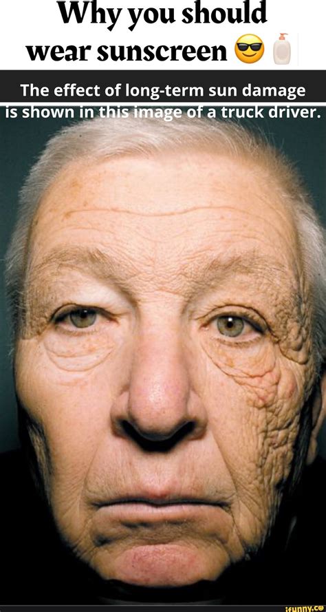 Truck Driver Sun Damage