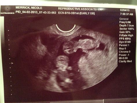 10 Week Ultrasound Twins