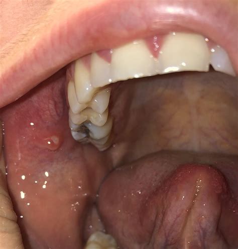 Raised bump on inner cheek. Mildly uncomfortable - what is it? : r ...