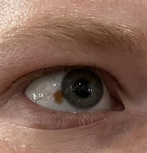 I have a freckle on my eye : r/mildlyinteresting