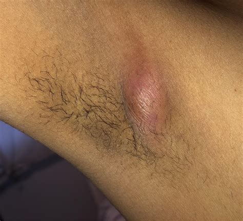 Pea Sized Lump In Armpit