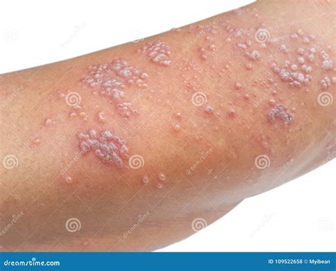 Herpes On Elbow