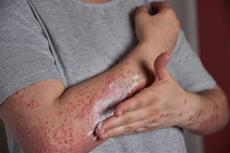 What are Shingles Stages? Treatment and Their Complications