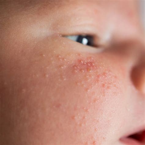 Sarpullido por calor en bebés: tratamientos y prevención | Minenito