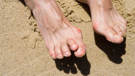 What Does a Hammertoe Look Like? Symptoms, Causes, and Treatment - GoodRx