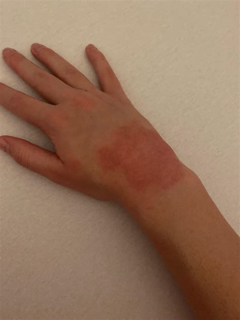 Red spots on hands- causes and advice? : r/medical_advice