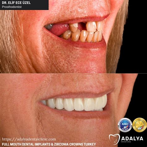 Tooth Implant Turkey Price 2025 - Affordable Tooth Implants Cost