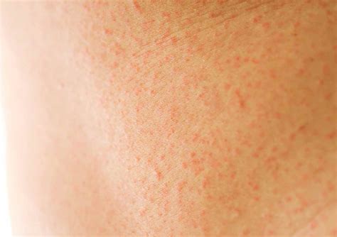 How to Stop & Prevent Thigh Chafing — Moody Sisters Skincare