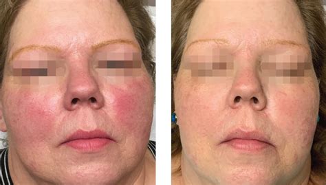 Rosacea Laser Treatment