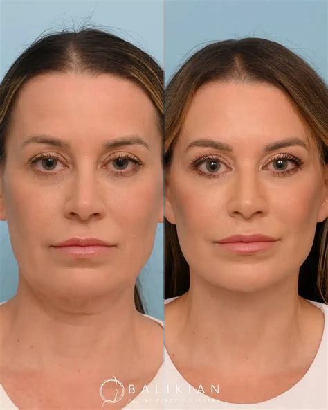 Deep Plane Artiste Lift™ + Fat Transfer | Why Volume Matters