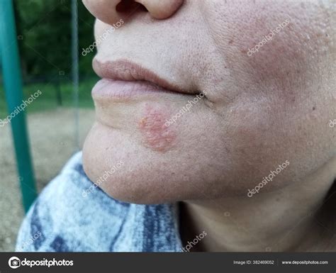 Red Itchy Rash Sore Blister Woman's Chin Face — Stock Photo ...