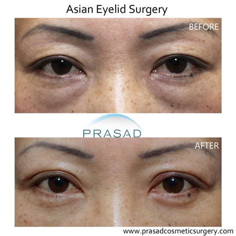 Double eyelid surgery aftercare online