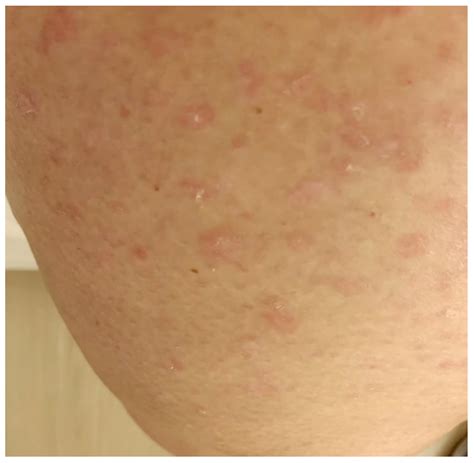 Pityriasis Lichenoides
