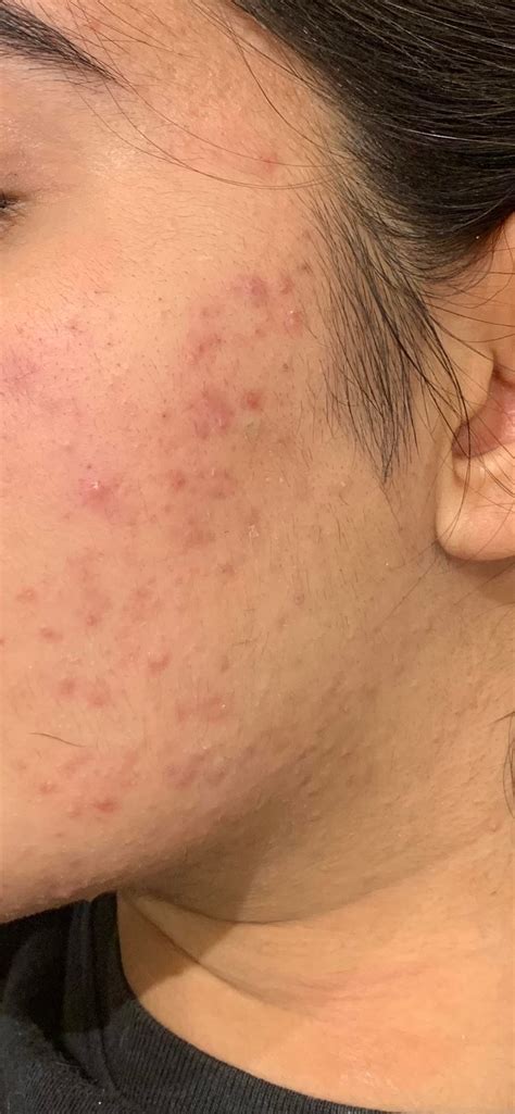 [Acne] only get this acne exclusively on my cheeks - anyone know what kind of acne this is and ...