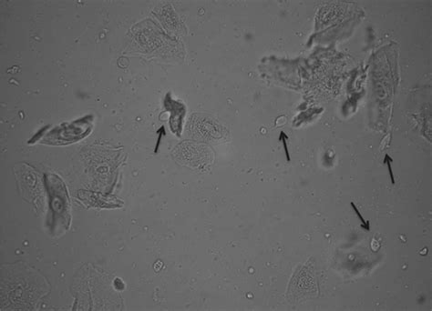 The clinical spectrum of Trichomonas vaginalis infection and challenges ...