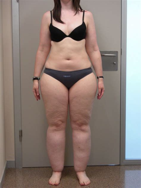 ¿Qué Es El Lipedema? _ LIPEDEMA: qué es, por qué se produce y tratamiento – SRXQ