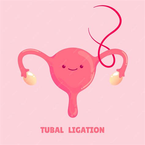 Premium Vector | Tubal ligation medical procedure vector illustration