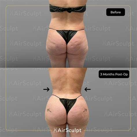 Three Treatments In One: See A Washington, D.C. AirSculpt ...