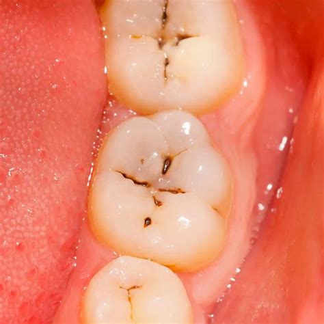 What Does a Cavity Look Like in Different Stages and Teeth?