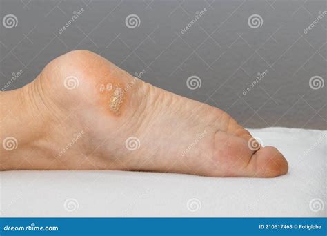 Plantar Wart Close Up On The Bottom Of A Female Foot Heel Caused By The Human Papillomavirus, Or ...
