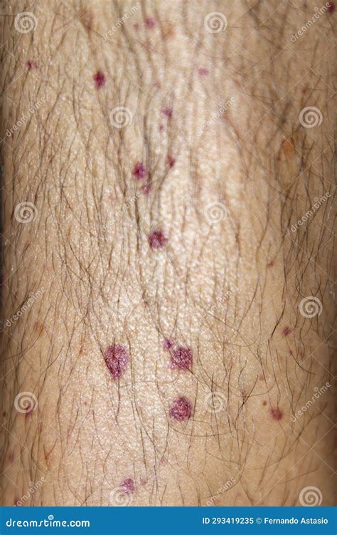 Vasculitis. Vasculitis in Legs. Small Red or Purple Spots. Rare Disease. Stock Image - Image of ...