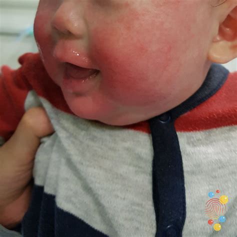 Rash In Babies