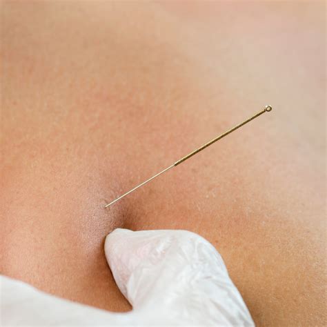 Dry Needling: A Key to Relieving Muscle Pain and Enhancing Mobility in ...
