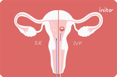 What Are the Factors That Affect IUI Success Rates?