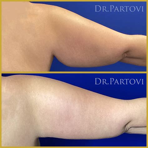 Arm Lift Brachioplasty Surgery in Culver City, CA | True Jewel Surgical Center