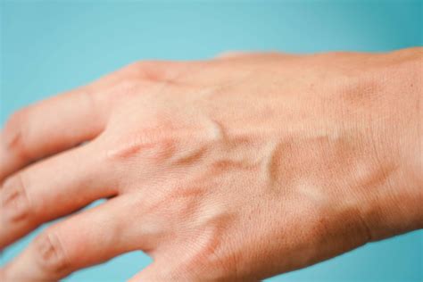 Hand Veins: Causes and Treatments