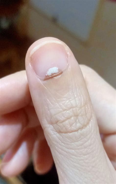 Dark spot spreading in my entire thumb nail cuticle and nail too. : r/NailFungus