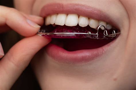 How Long Does A Retainer Strap Stay In After Expander Adjustment