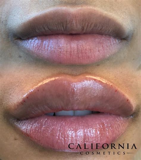 Lip Filler Juvederm Ultra Plus at Angus Champion blog
