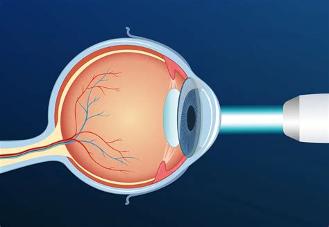 Yag Laser Treatment Eye