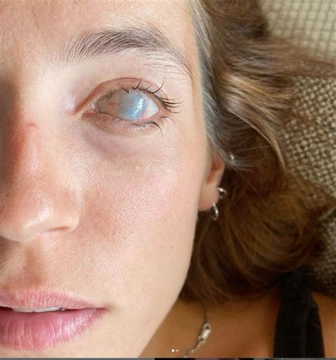 cherry | Scar, Eye scar, Face scars