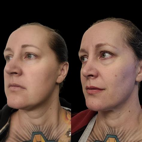 2.5 years post op rhinoplasty and double chin lipo : r/PlasticSurgery