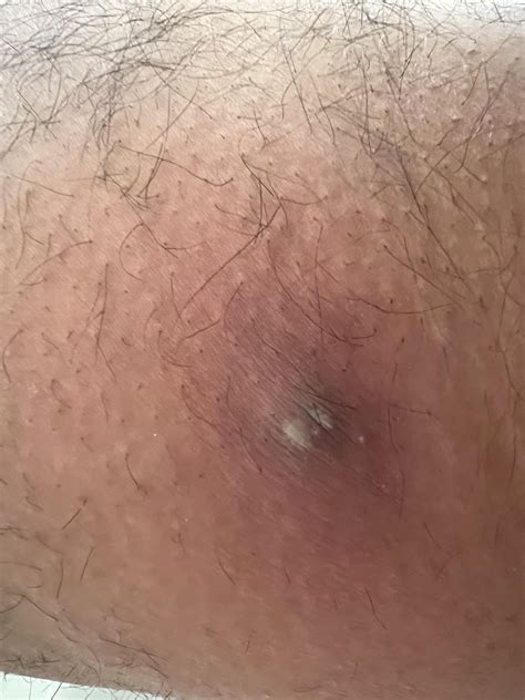 Painful Lump on Inner Thigh : r/medical