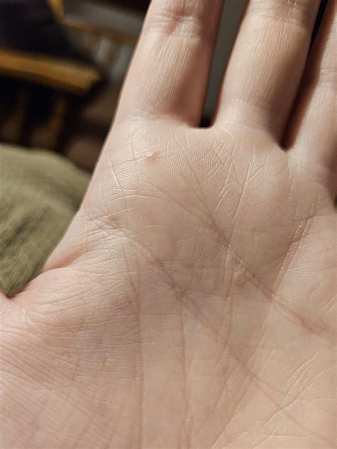 Itching bumps on hands and wrists : r/DermatologyQuestions