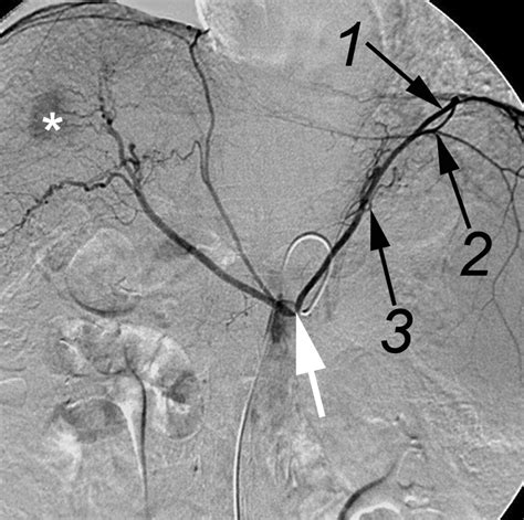Inferior Phrenic Artery: Anatomy, Variations, Pathologic Conditions, and Interventional ...