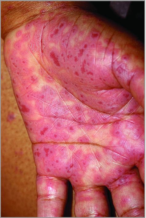 Stevens Johnson Syndrome Hands