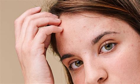 What Causes Acne? Foods To Avoid And How To Treat Pimples