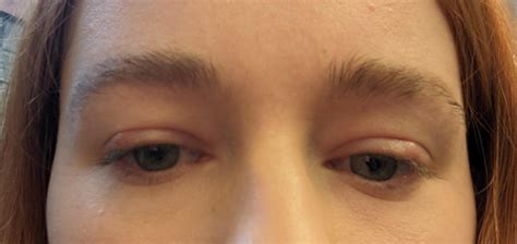 Red, swollen painful eyelids : r/DiagnoseMe