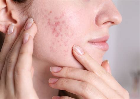 Acne Scar Treatment at Define Clinic for Clear Skin
