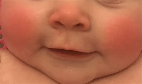 Red Cheeks During Teething Baby at Maria Baum blog
